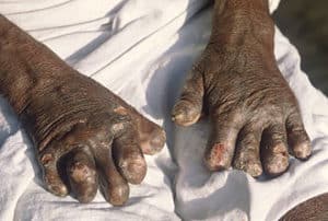 Leprosy deformed hands