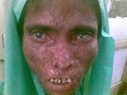 Patient with severe leprosy