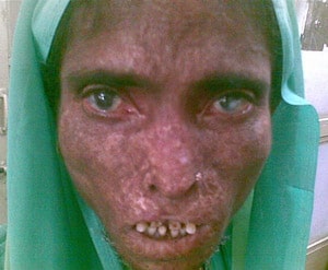 Leprosy Sufferer